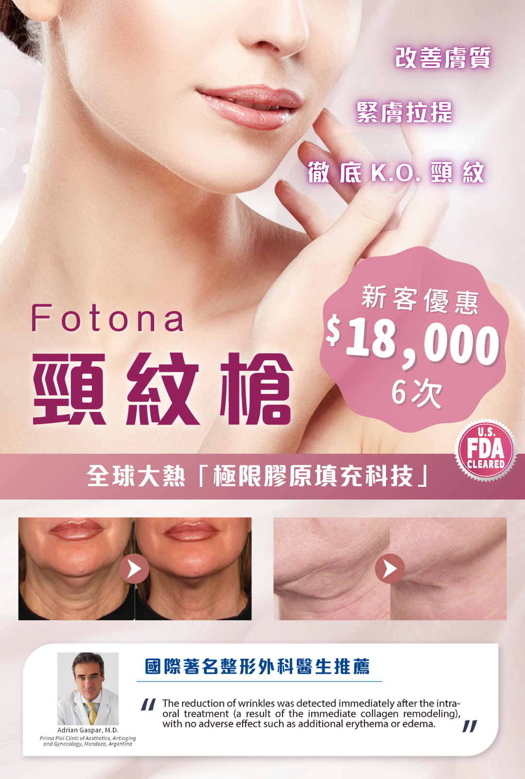 Fotona 頸紋槍
