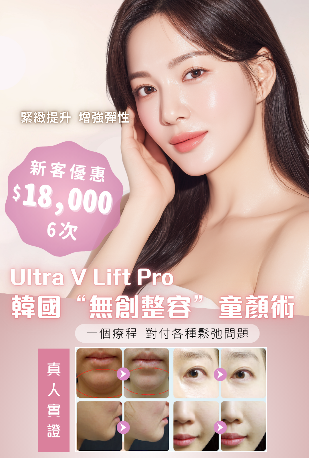 Ultra V Lift Pro韓國“無創整容”童顏術